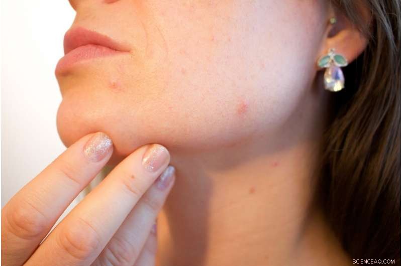 Sarecycline: The Breakthrough Antibiotic Revolutionizing Acne Treatment