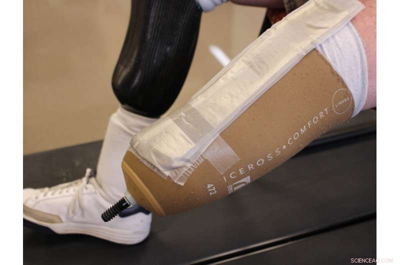 Smart Textile Patch with Conductive Yarns Detects Pressure Points on Amputee Prosthetics