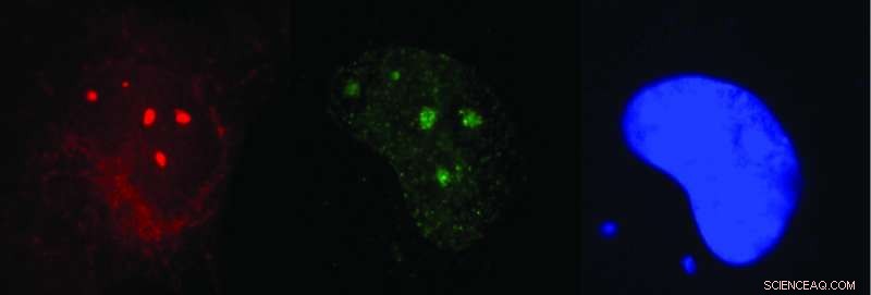 Diabetes Drug Accelerates UV DNA Repair in Children with Xeroderma Pigmentosum