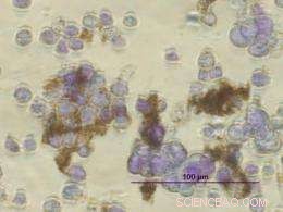 Magnetic Nanoparticles Offer New Hope in Human Cancer Treatment