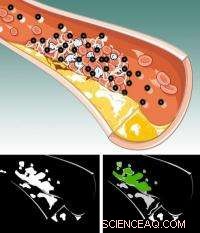 Breakthrough Nanoparticles Illuminate Blood Clots for Early Detection