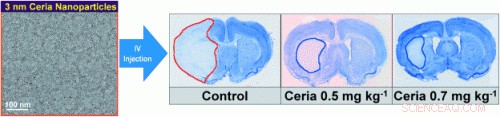 Ceria Nanoparticles Show Promise in Reducing Ischemic Stroke Damage
