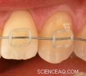 Nanoparticles Enhance Durability of Invisible Orthodontic Brackets