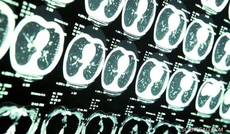 Nanoparticle Therapy Targets and Eliminates Aggressive Brain Tumors