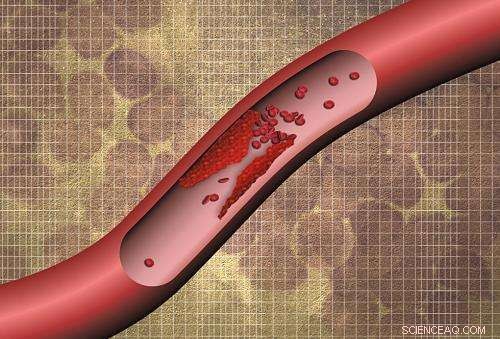 Nanotech Urine Test Quickly Detects Life‑Threatening Blood Clots