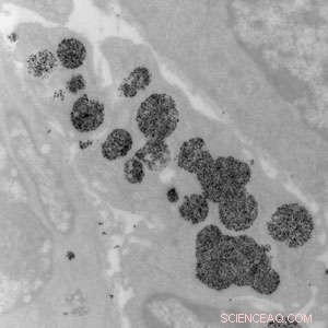 How Magnetic Nanoparticles Transform Breast Cancer Treatment