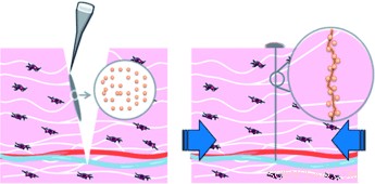 Nanoparticles Provide Needle-Free, Thread-Free Wound Closure