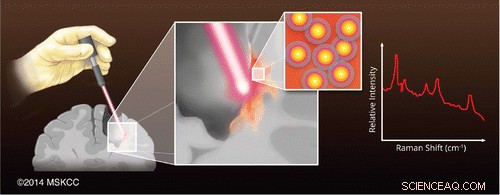 Handheld Scanner Enhances Complete Brain Tumor Removal, Reducing Recurrence Rates