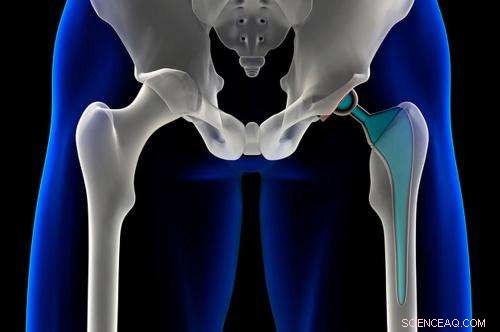 Scientists Search for Nanostructures Enhancing Metal‑Bone Compatibility
