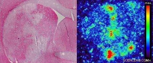 Sweet Nanoparticles Offer New Hope for Stroke Treatment