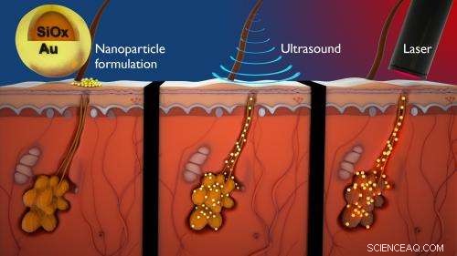 Cutting‑Edge Nanotech and Transdermal Delivery Target Acne: New Research Breakthrough