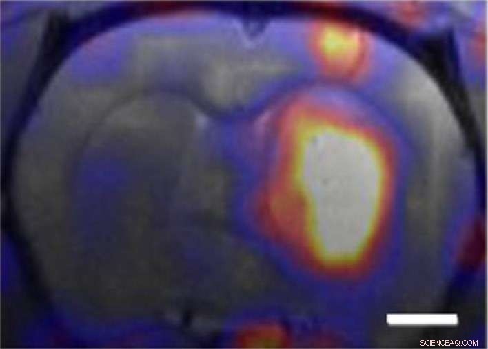 Nanocarriers Offer New Hope for Treating Glioblastoma