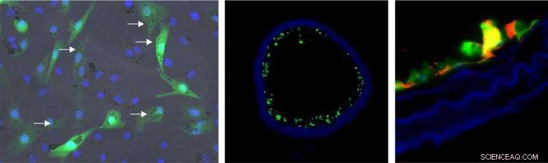 Nanoparticle Therapy: A Breakthrough Approach to Treating Arteriosclerosis