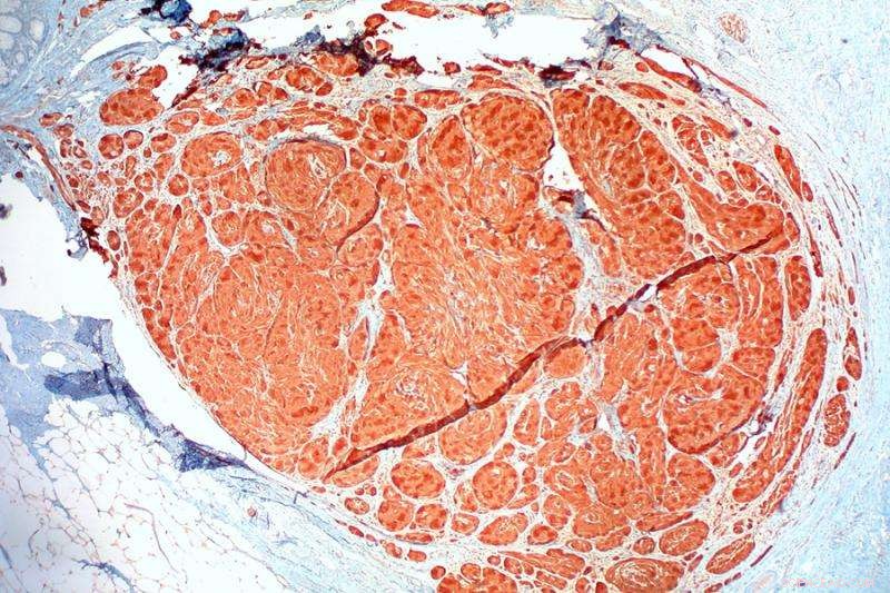 Targeted Nanocrystal Drugs: A New Frontier in Treating Cancer and Neurodegenerative Diseases