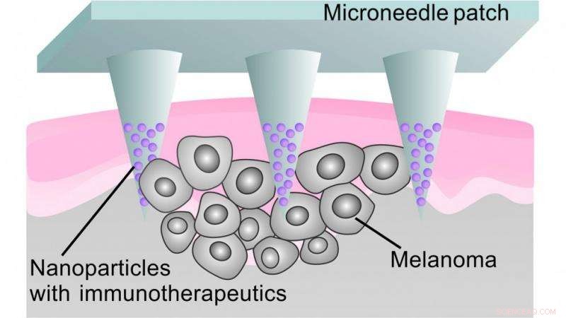 Microneedle Patch Offers Targeted Melanoma Immunotherapy