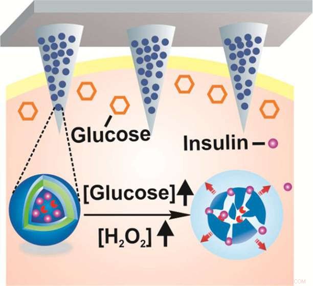 Smart Patch Automatically Delivers Insulin on Demand