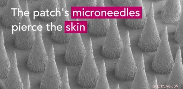 Microneedle Skin Patch Turns Fat into Energy-Burning Brown Fat—A Breakthrough for Obesity and Diabetes Treatment