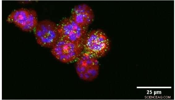 Scientists Employ Nanoparticles to Target and Destroy Endometrial Cancer Cells