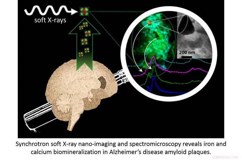 Metallic Triggers in Alzheimer’s: Unveiling Iron and Calcium’s Role in Plaque Formation