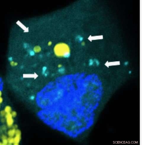Johns Hopkins Breakthrough: Nanoparticle Genetic Packets Target Brain Cancer Stem Cells