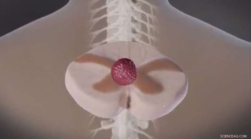 Magnetic Nanoparticles Deliver Chemotherapy Directly to Spinal Tumors