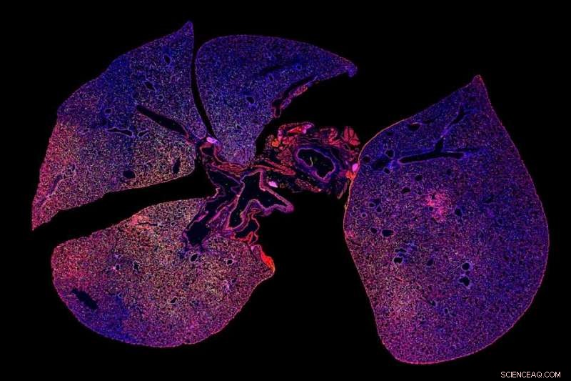 Nanoparticles Enable Simple Urine Test for Rapid Bacterial Pneumonia Diagnosis