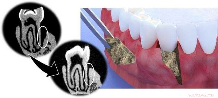 Innovative Periodontal Membrane Promotes Tissue and Bone Regeneration – A Promising Treatment for Periodontitis