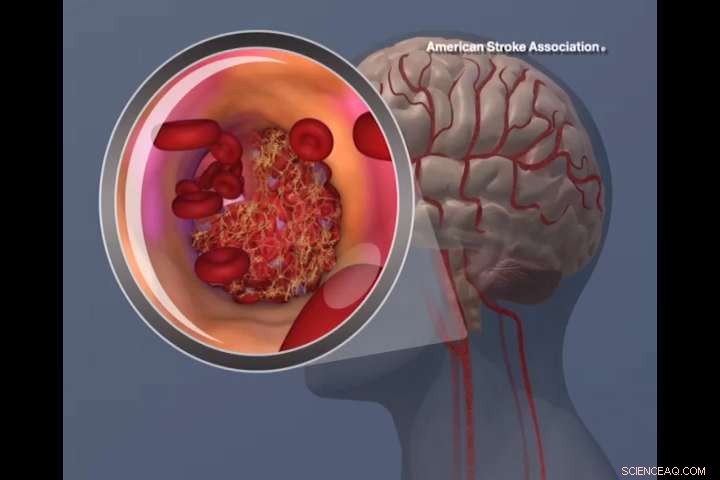 Nanoparticle Liposome Transporters Offer New Hope for Early Stroke Treatment