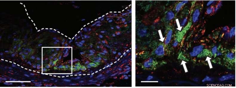 Innovative Nanoparticles Target and Eliminate Atherosclerotic Plaques to Reduce Heart Attack Risk