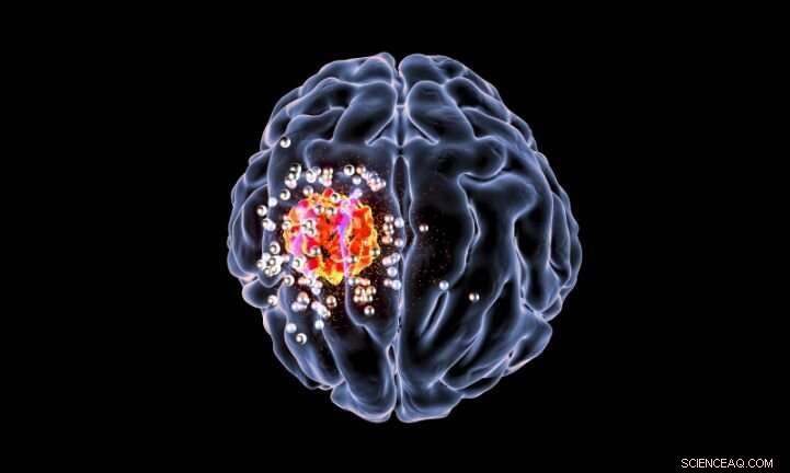 Tiny Nanoparticles Offer New Hope for Treating Aggressive Brain Cancer