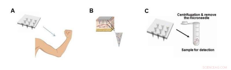 Efficient Extraction of Skin Interstitial Fluid with Custom Microneedle Patches