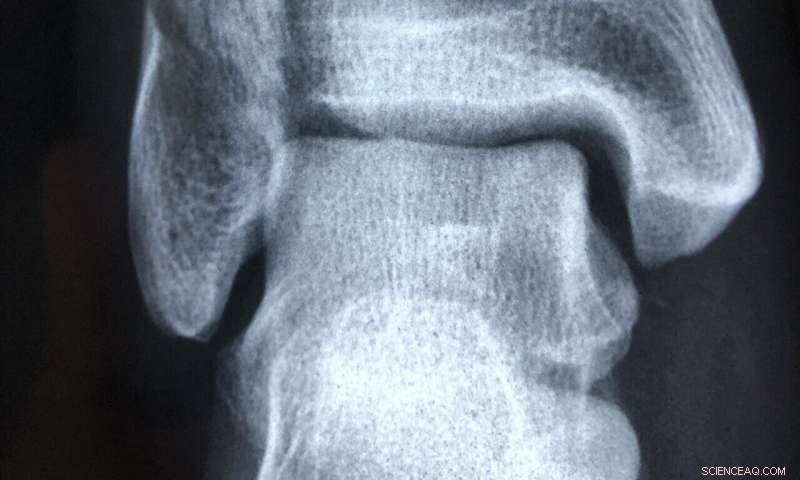 Innovative Device Combines Scaffold and Electrical Stimulation to Accelerate Bone Healing