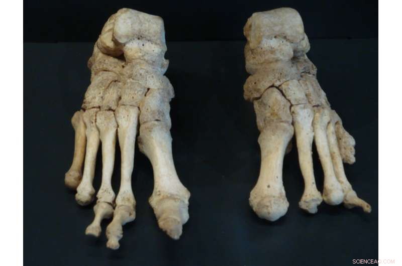 Leprosy in the Middle Ages: Impact on Health and Lifespan