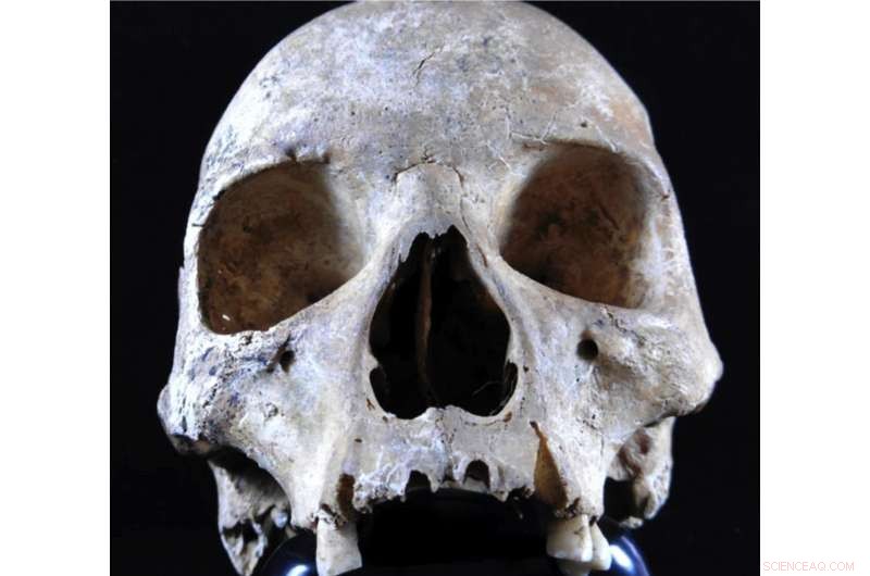 Could Squirrel Trade Have Sparked England’s Medieval Leprosy Outbreak?