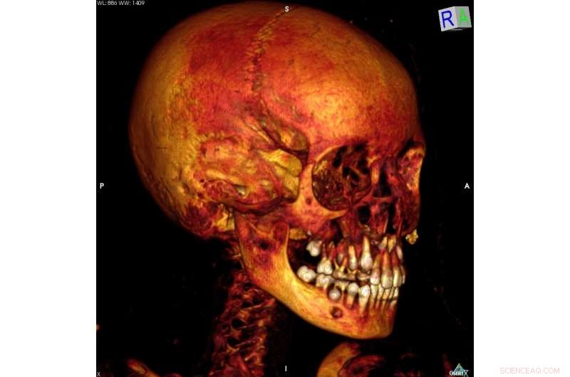 Ancient Mummies Reveal Earliest Known Breast Cancer and Myeloma Cases via CT Scans