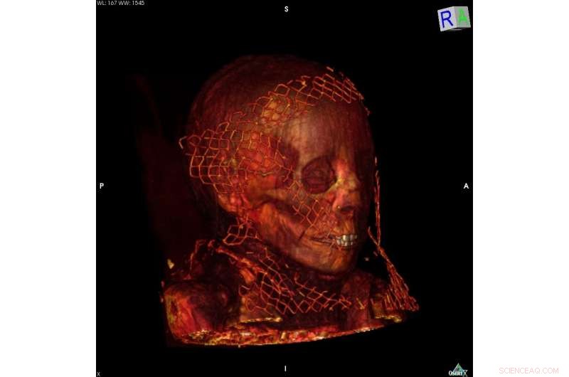Ancient Mummies Reveal Earliest Known Breast Cancer and Myeloma Cases via CT Scans