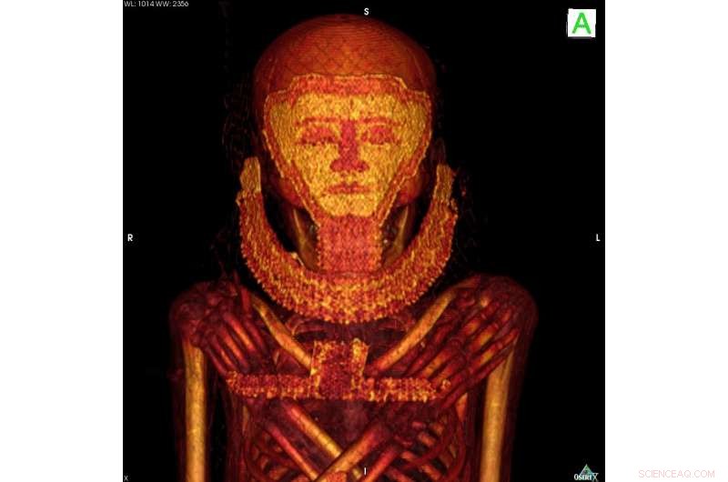 Ancient Mummies Reveal Earliest Known Breast Cancer and Myeloma Cases via CT Scans