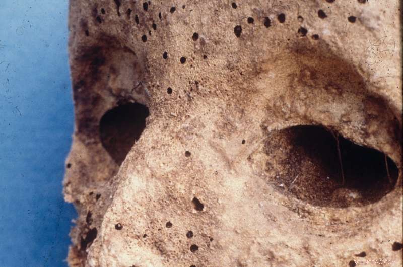 Ancient Mummy’s DNA Reveals Hepatitis B, Not Smallpox