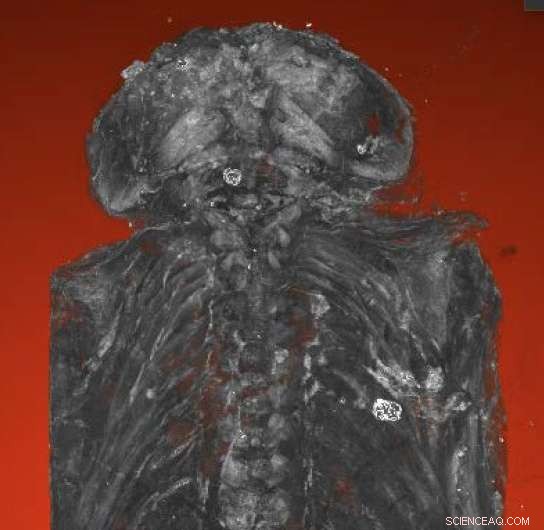 Micro-CT Reveals 2,100-Year-Old Mummy Is a Stillborn Human with Severe Birth Defects