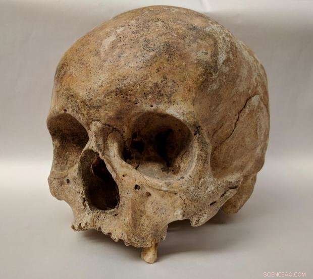 DNA of Leprosy Discovered in 700-Year-Old Skeletons from Odense, Denmark