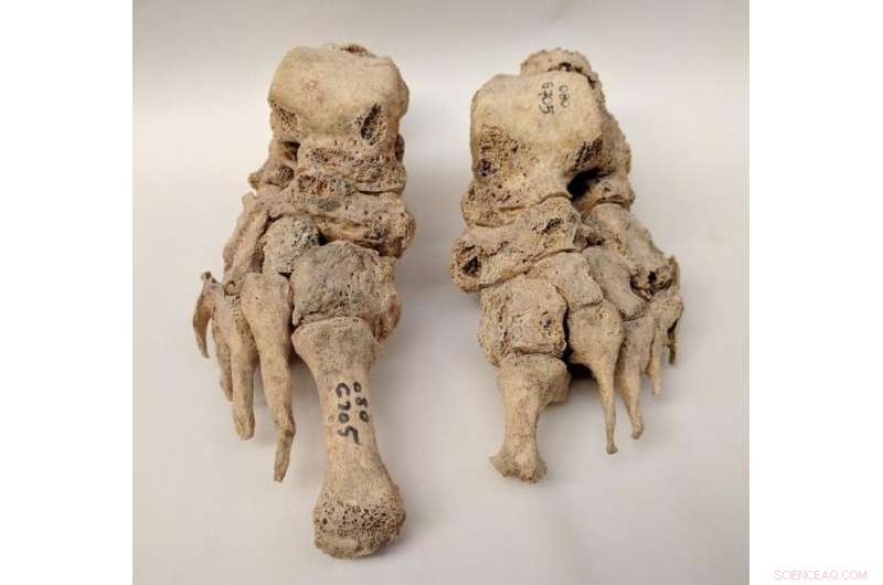 DNA of Leprosy Discovered in 700-Year-Old Skeletons from Odense, Denmark