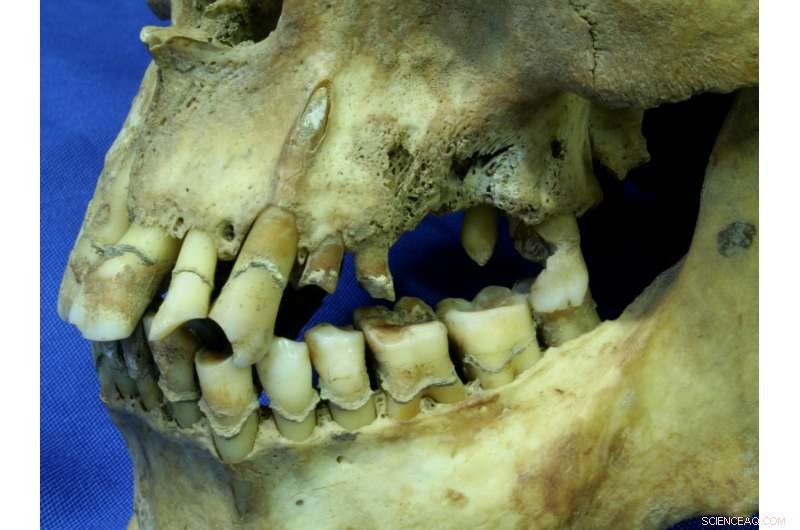 New Study Links Heavy Smoking to Dental Decay Among Irish Famine Victims