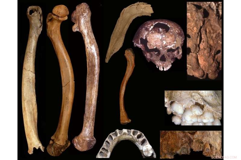 High Frequency of Developmental Anomalies in Pleistocene Humans Revealed by Anthropological Study