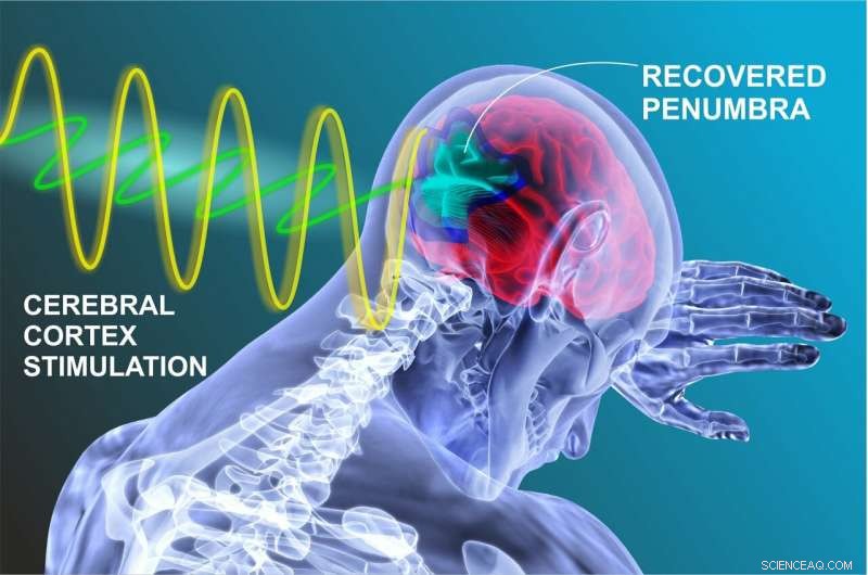New Mathematical Model Offers Personalized Stroke Rehabilitation Strategy