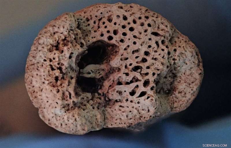 Paget’s Disease Unearthed in Medieval Skeletons Across Northwest Britain