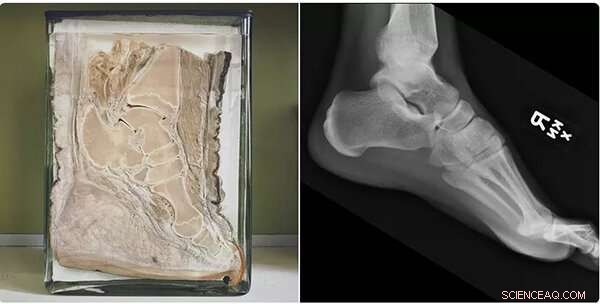 Rhoetosaurus: Australia s Jurassic Sauropod Revealed as a  High-heeled  Walker