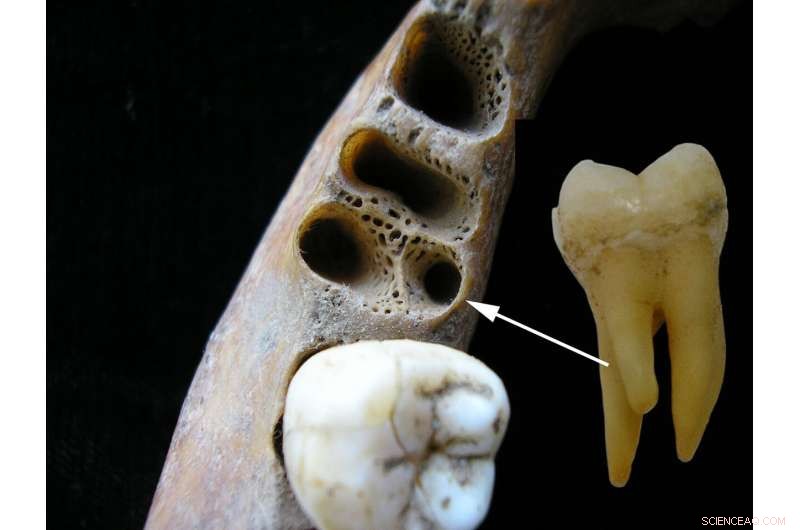 Molar Discovery Confirms Interbreeding Between Denisovans and Modern Humans in Asia