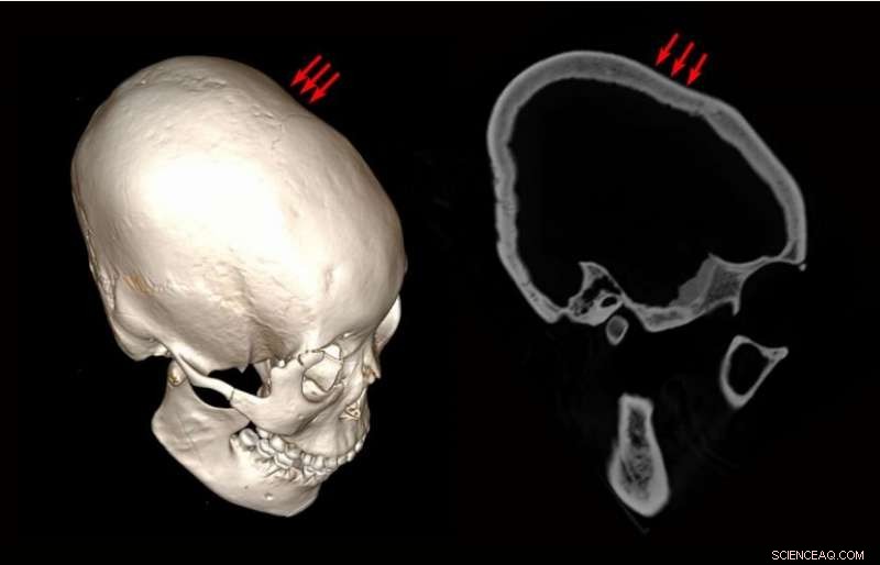 China Researchers Uncover Some of the World’s Oldest Cranial Modifications