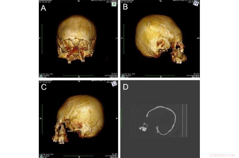First Evidence of Ancient Cranial Deformation in Croatia (5th‑6th Century)