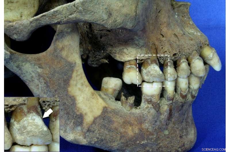 Dental Calculus Analysis Uncovers Famine Diets in Kilkenny Workhouse